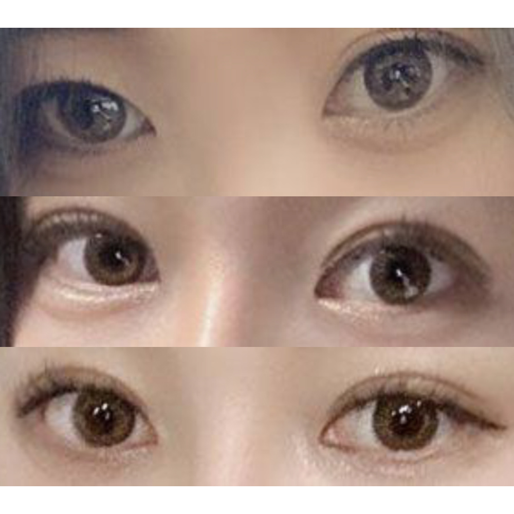 Mình đã phẫu thuật lại mắt thành công một cách tự nhiên!