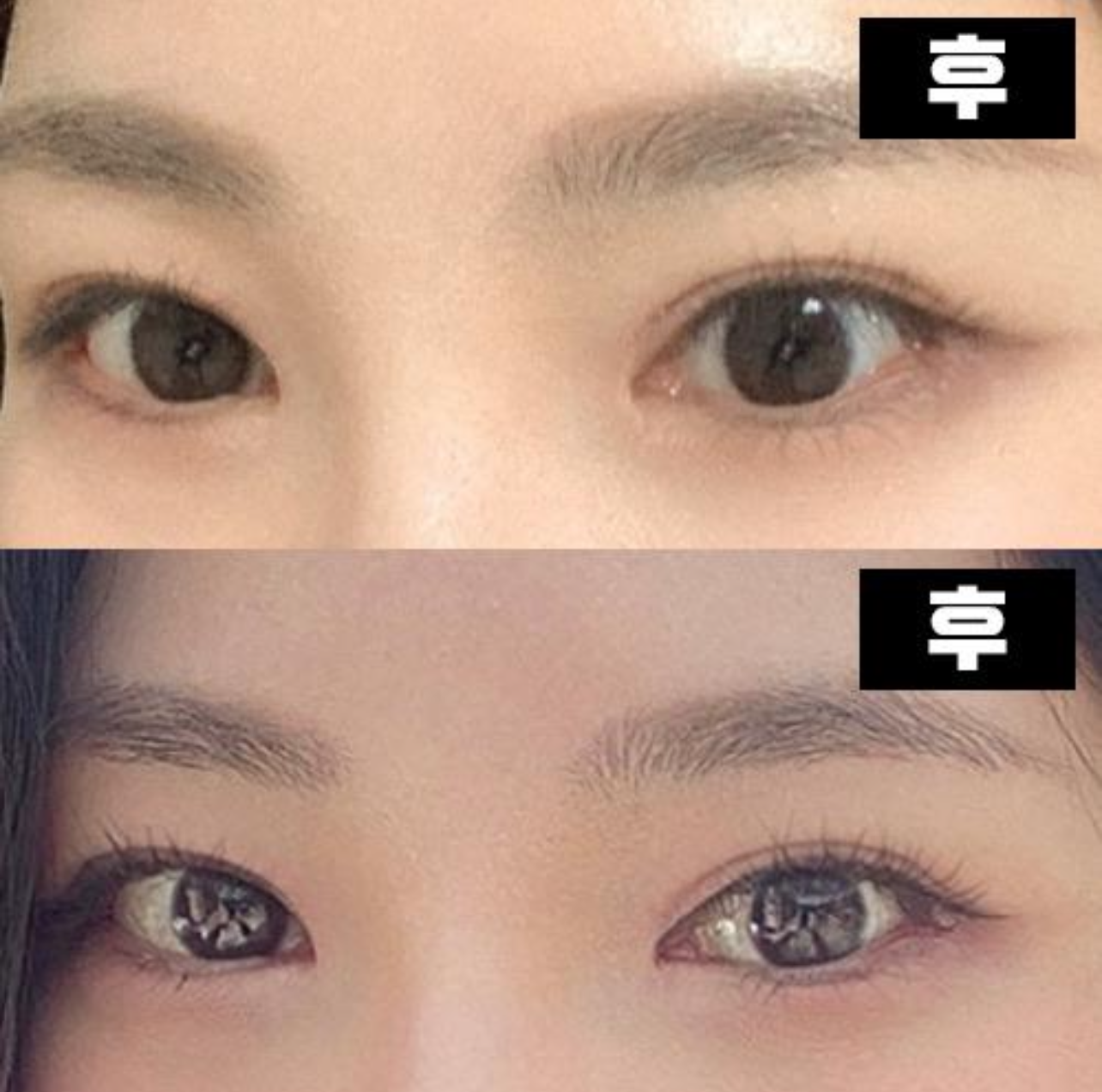 Mình thực sự giới thiệu nó nếu bạn lo lắng về phẫu thuật cắt mí ~