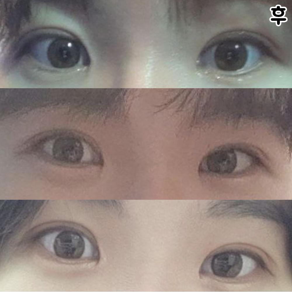 Mình đã từng thiếu tự tin vì mắt bị sụp nhưng sau phẫu thuật mình đã tự tin hơn ㅠㅠㅠㅠ