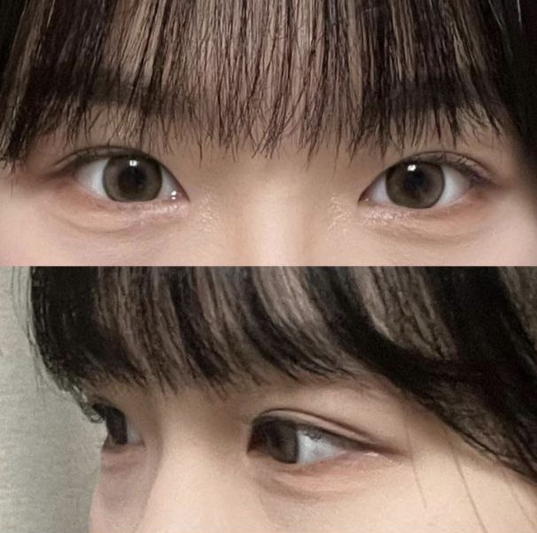 Mình đã quyết định phẫu thuật tại Weaver Plastic Surgery vì họ đã tư vấn cho mình rất kỹ càng!