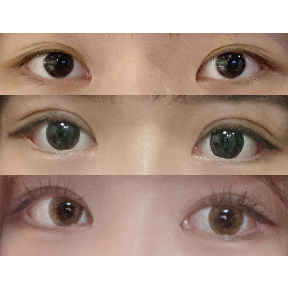 Review hậu phẫu thuật hạ góc mắt dưới + khâu hai mí tự nhiên + chỉnh sửa mắt!