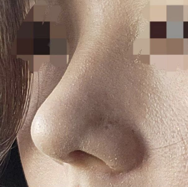 Mình rất hài lòng với kết quả phẫu thuật!