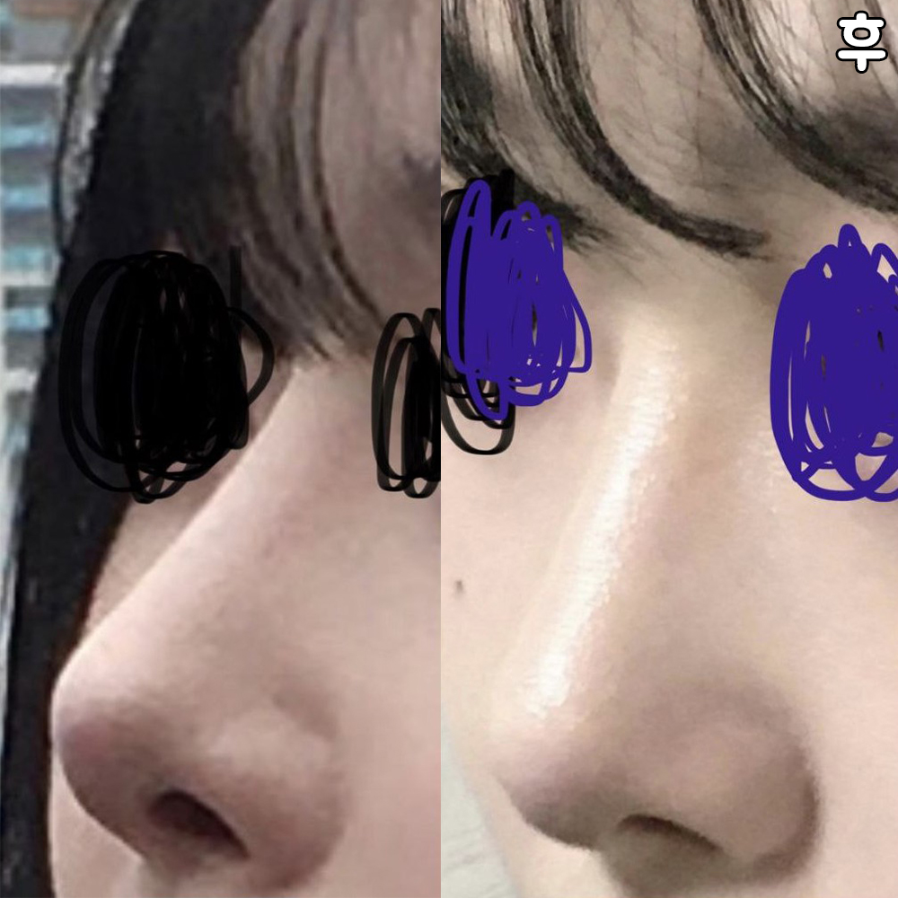 Mọi người đều nói mũi đẹp lắm