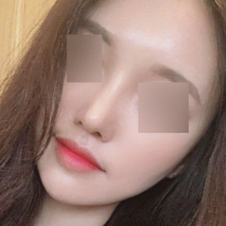 Mình đã phẫu thuật mũi ở Weverse được ba tháng rồi!