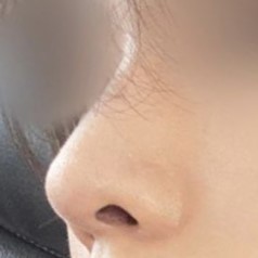 Mọi người nói rằng trông tự nhiên đến mức họ không biết mình đã phẫu thuật thẩm mỹ mũi.