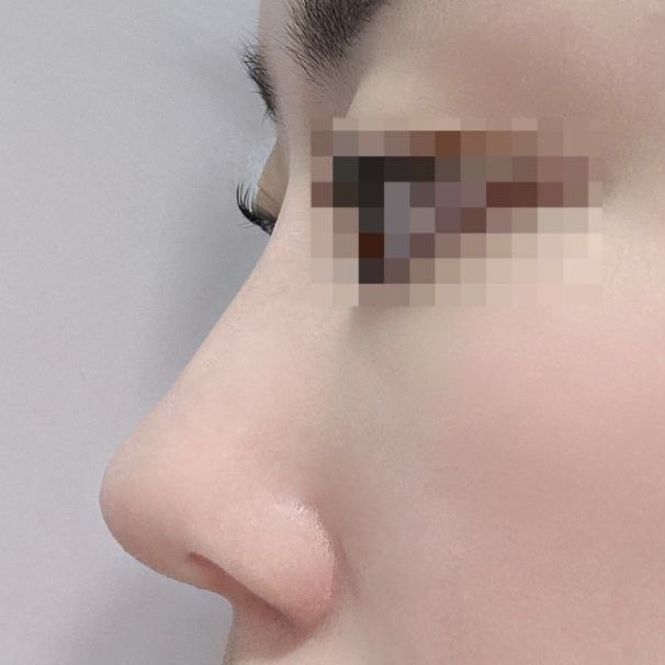 Mình rất thích! Mình rất mong chờ đến khi hết sưng sau một tháng!