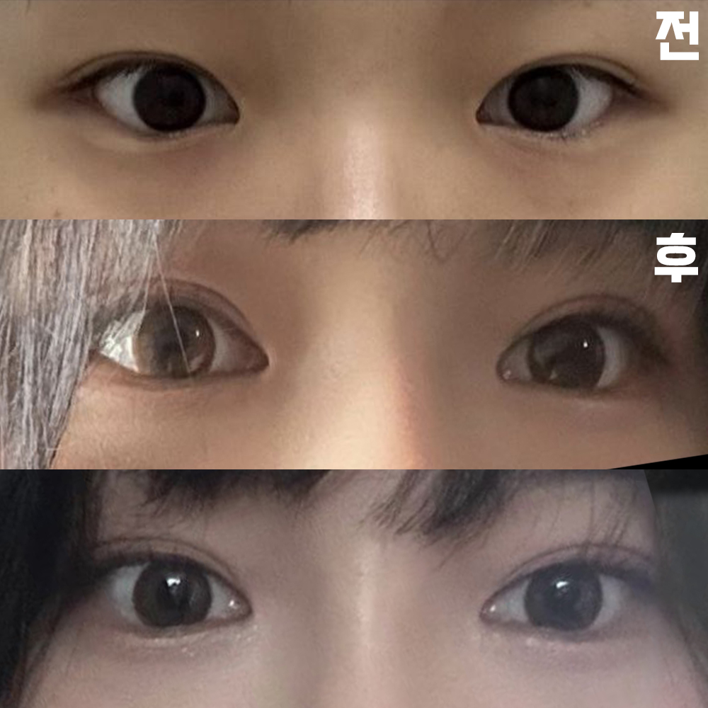 Mình rất hạnh phúc vì kết quả thật thỏa mãn. Cảm ơn bác sĩ!!