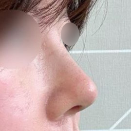 Mình cũng hoàn toàn ngạc nhiên khi thấy sự khác biệt giữa ảnh trước và sau khi phẫu thuật ㅎㅎ