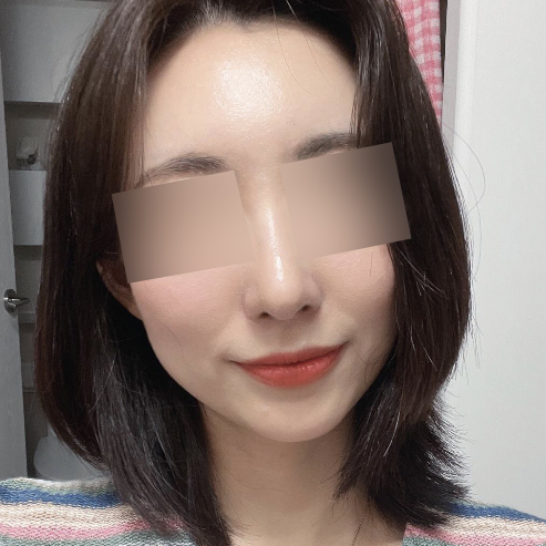 Mình đã cấy mỡ tự thân vào mũi + trán!!