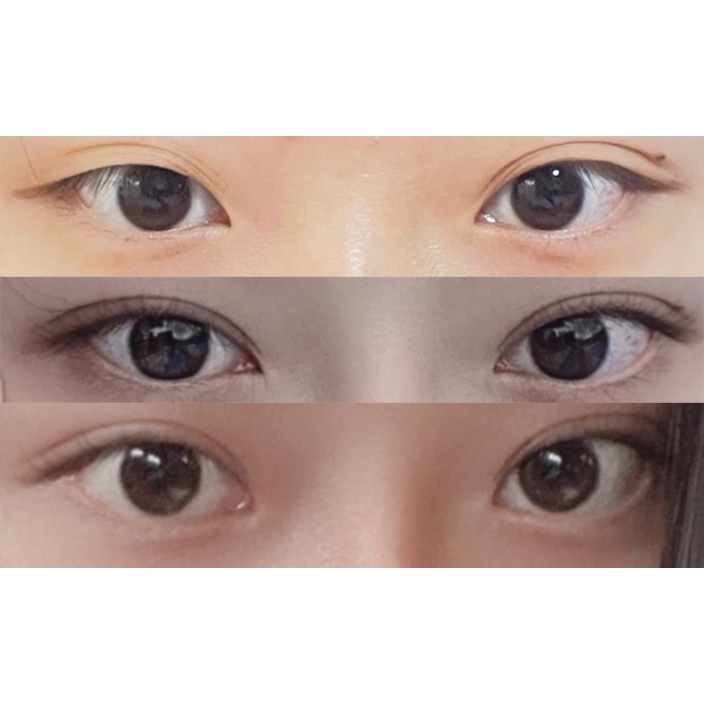 Mình đã phẫu thuật mắt và mũi cùng nhau ㅎㅎ