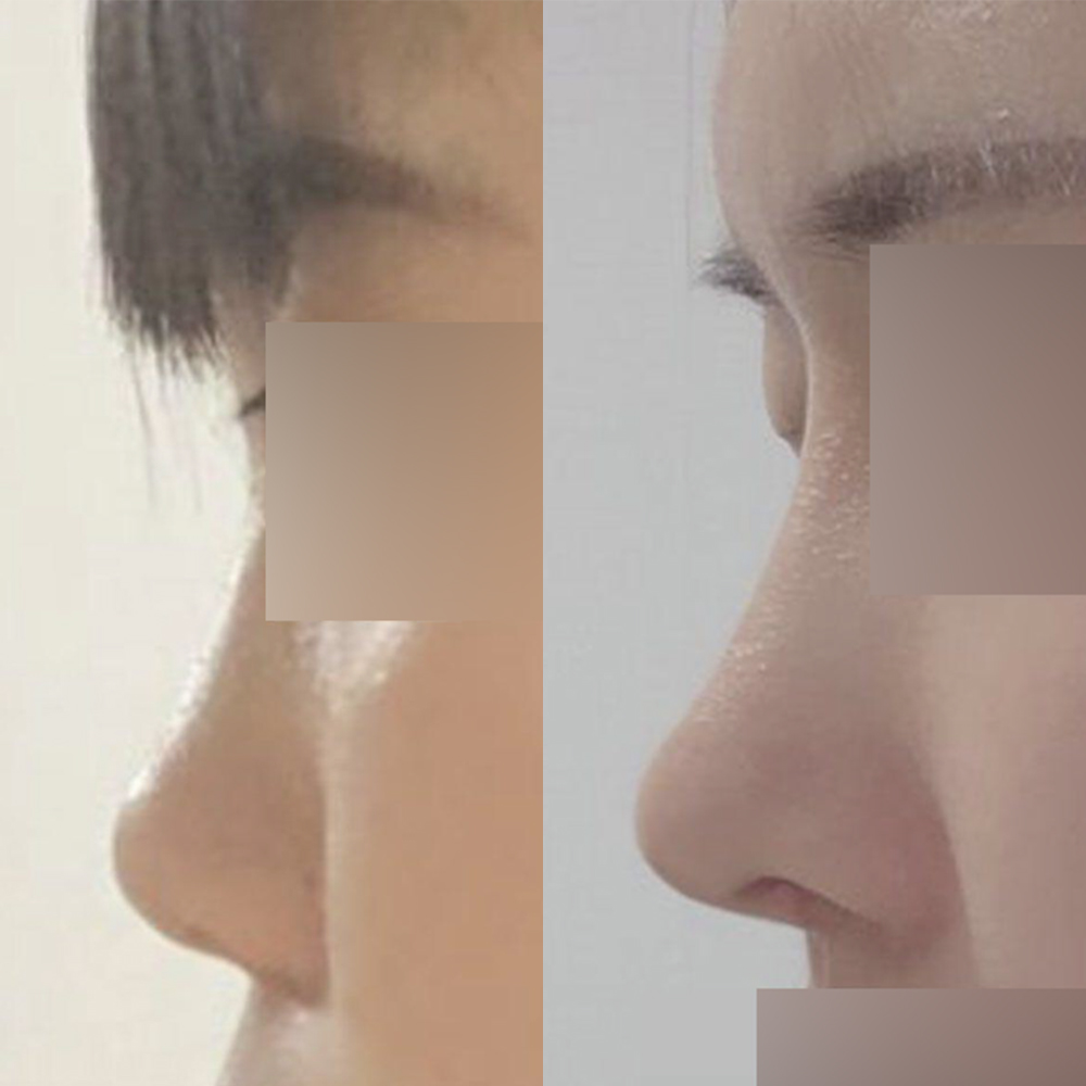 Đã 8 tháng kể từ khi mình phẫu thuật mắt và mũi!