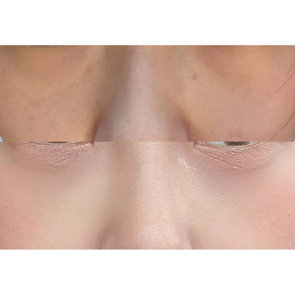 Mình đã cải thiện bọng mắt dưới khiến mình trông mệt mỏi ㅎ