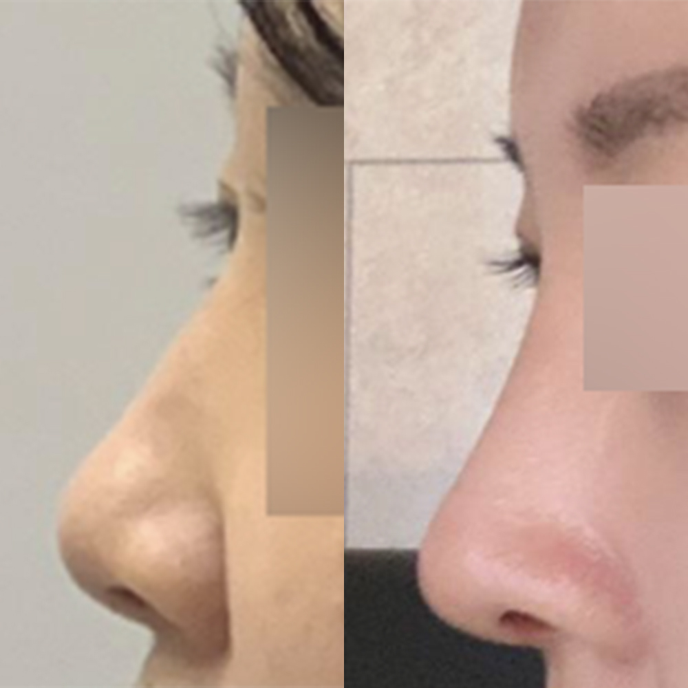 Mình đã phẫu thuật mũi lần đầu!