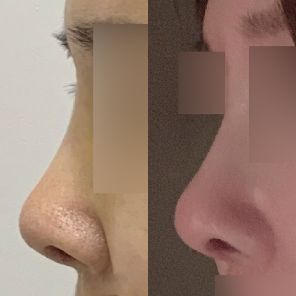 Mình đã phẫu thuật mũi một cách bất ngờ 5 năm trước :-)))