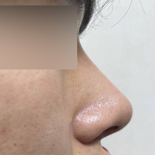 Đã 2 tháng kể từ khi mình phẫu thuật mũi với bác sĩ Shim