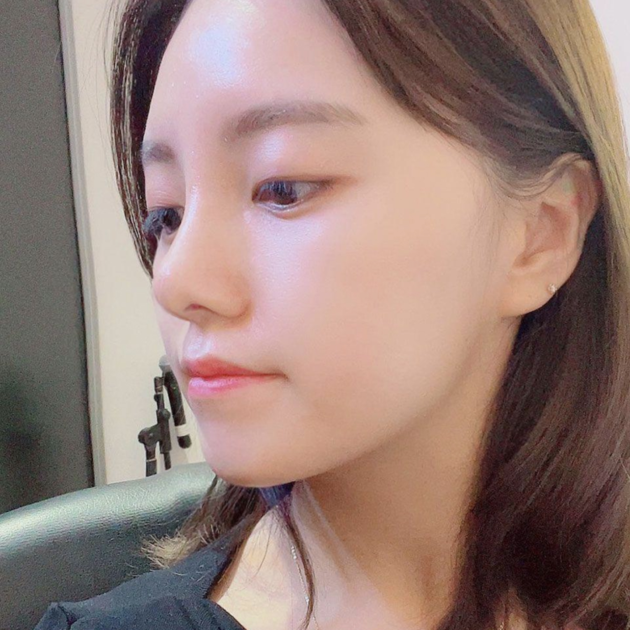 Đã được 1 tháng kể từ khi mình phẫu thuật thẩm mỹ mũi tại Weavers