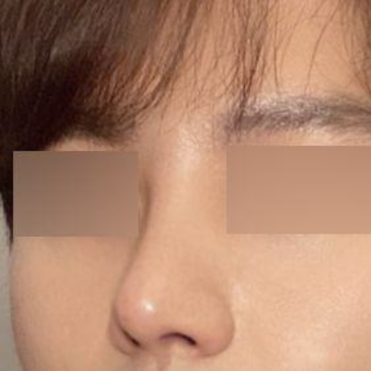 Đánh giá sau phẫu thuật lại mũi lần 3 / Phẫu thuật mắt lần đầu