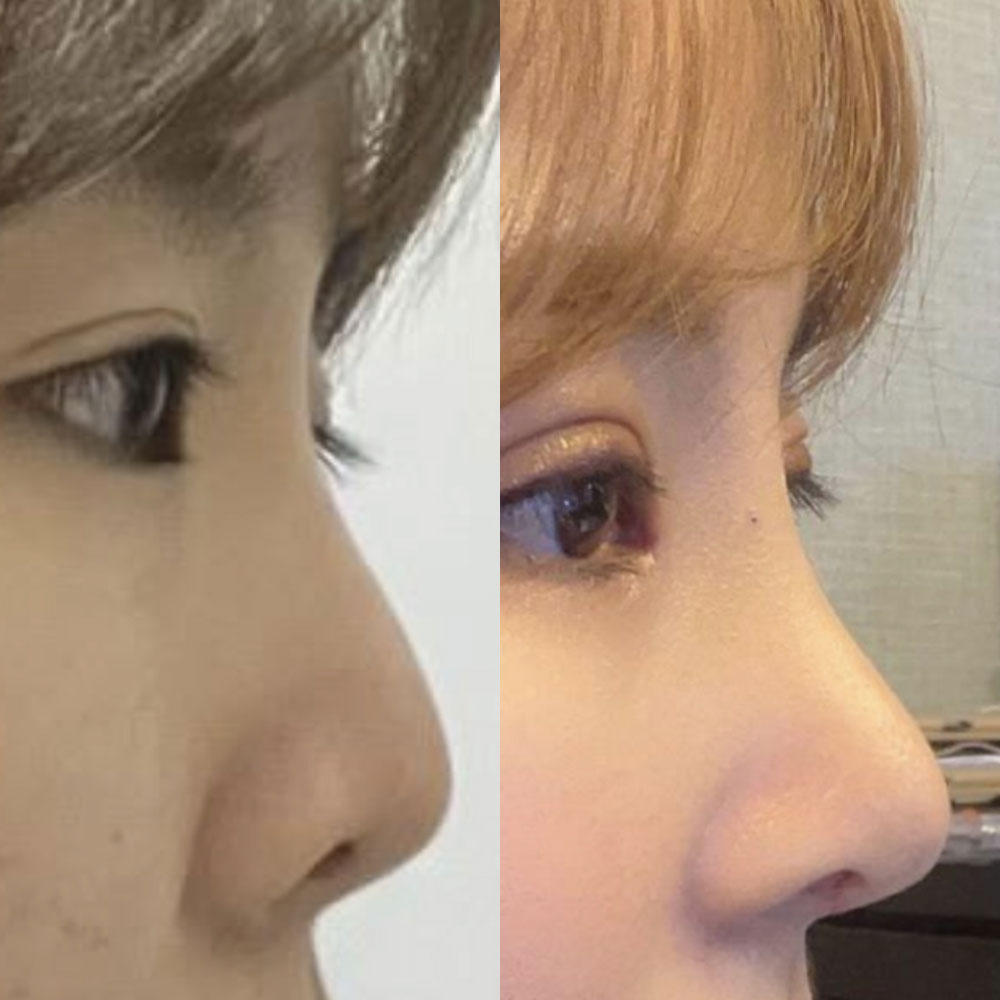 Mình đã phẫu thuật lại mũi với bác sĩ Seo và phẫu thuật lại mắt với bác sĩ Shim