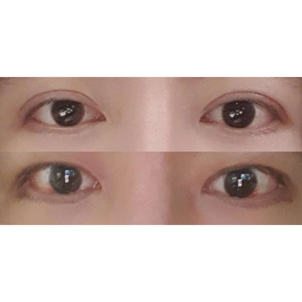 10 ngày sau phẫu thuật thu nhỏ mắt hai mí và chỉnh sửa mắt cho nam giới