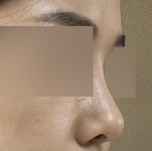 Bài đánh giá sau hơn 3 tháng phẫu thuật~