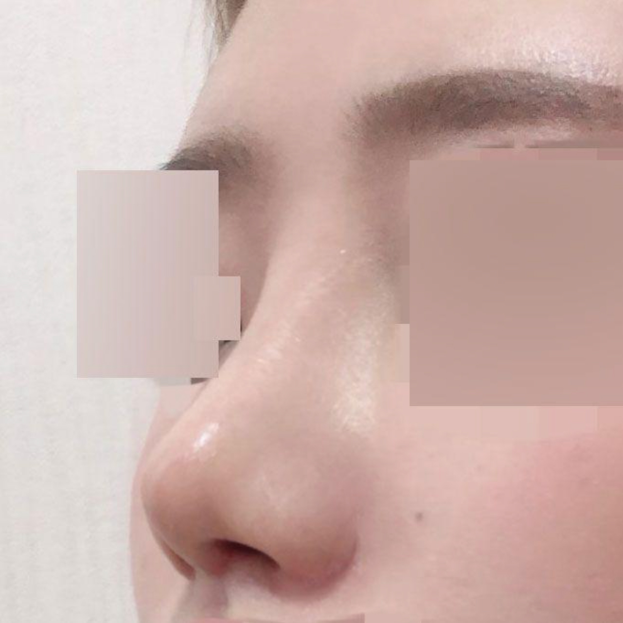 Mình đã phẫu thuật lại mũi tròn!