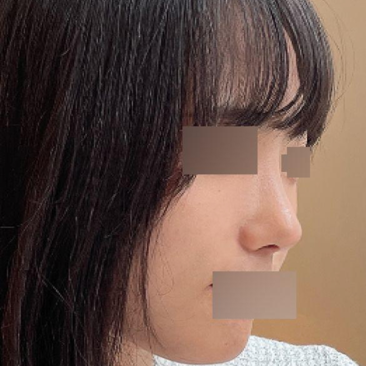 Đã 3 tháng kể từ khi phẫu thuật thu nhỏ đầu mũi