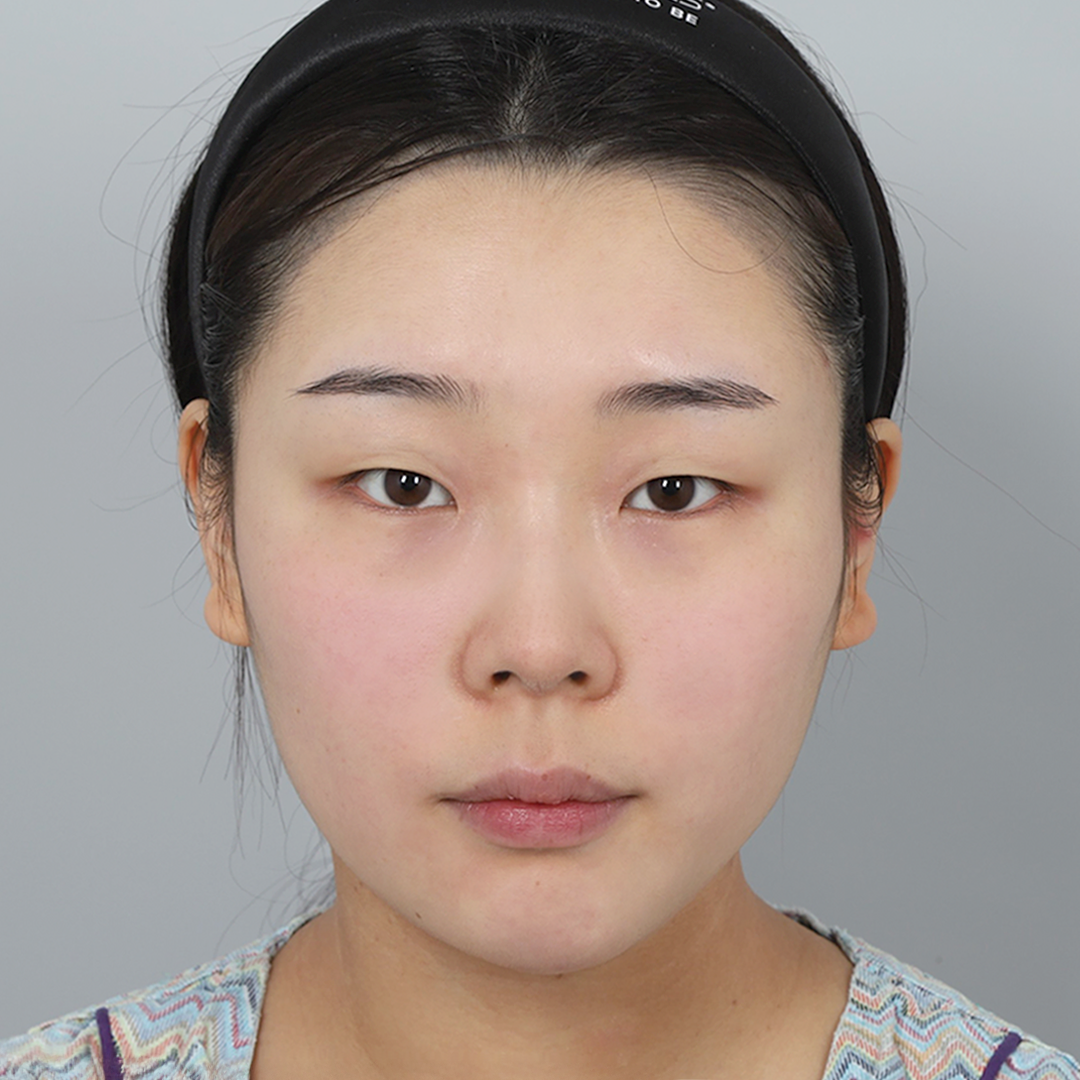 #Cắt mí một phần #Mở góc mắt trên #Loại bỏ mỡ mí trên #Sống mũi (silicone) #Đầu mũi (sụn tự thân)