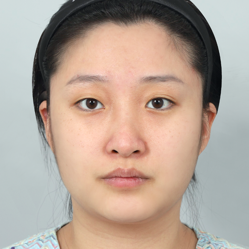 #Rạch một phần #Đầu mũi (sụn tự thân) #Phẫu thuật nâng mũi không dùng implant #Chỉnh sửa mũi gồ mũi tên