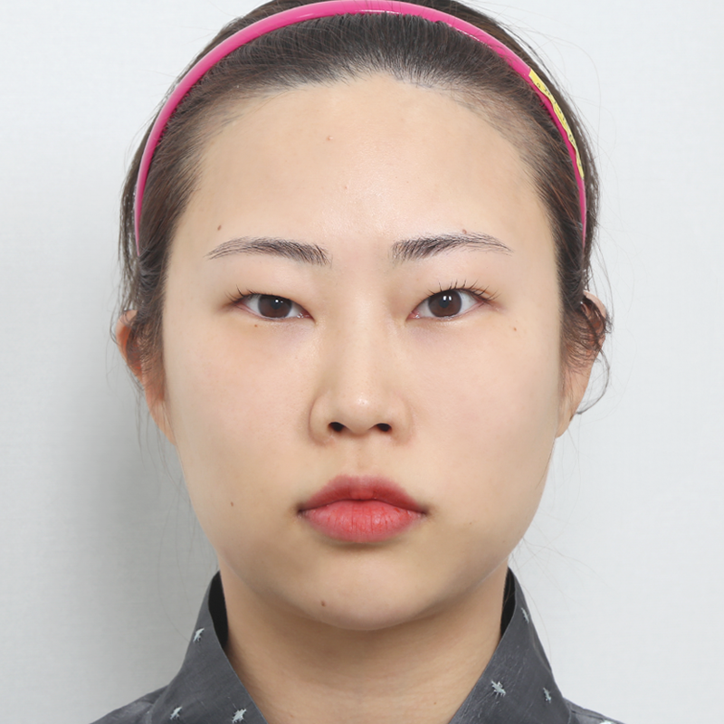 #Cắt mí một phần #Mở góc mắt trên #Mở góc mắt dưới và sau #Loại bỏ mỡ thừa mí trên #Nâng sống mũi (silicone) #Phẫu thuật mũi bằng sụn sườn tự thân