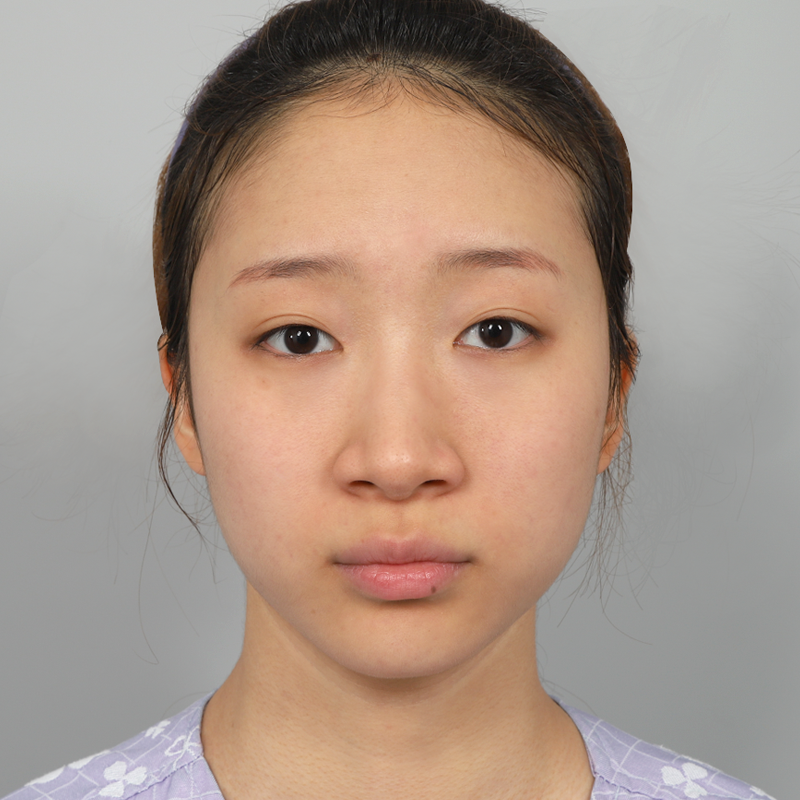 #Sốngmũi(silicone) #Đầumũi(sụn tự thân) #Thu nhỏ cánh mũi