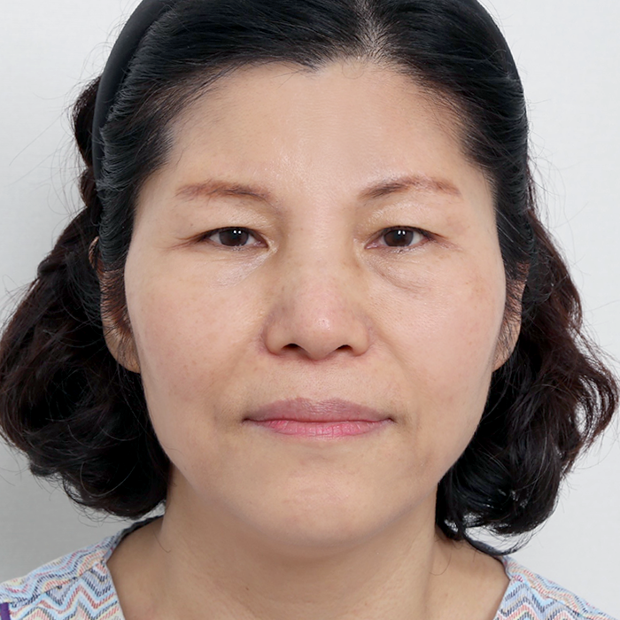 #Cắt mí dưới #Nâng trán (endotine) căng da mặt