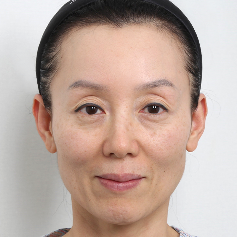 #Cấy mỡ trên mí mắt #Cấy mỡ toàn mặt dưới mí mắt