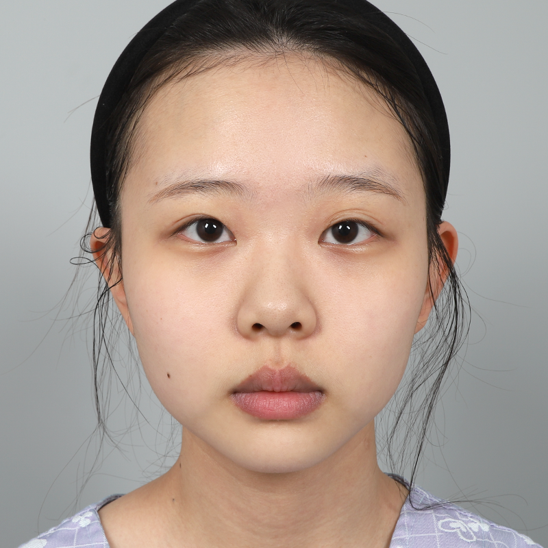 #Cắt mí một phần #Mở góc mắt trên #Giải phóng dính #Sống mũi (silicon) #Đầu mũi (sụn tự thân) Tái phẫu thuật mắt