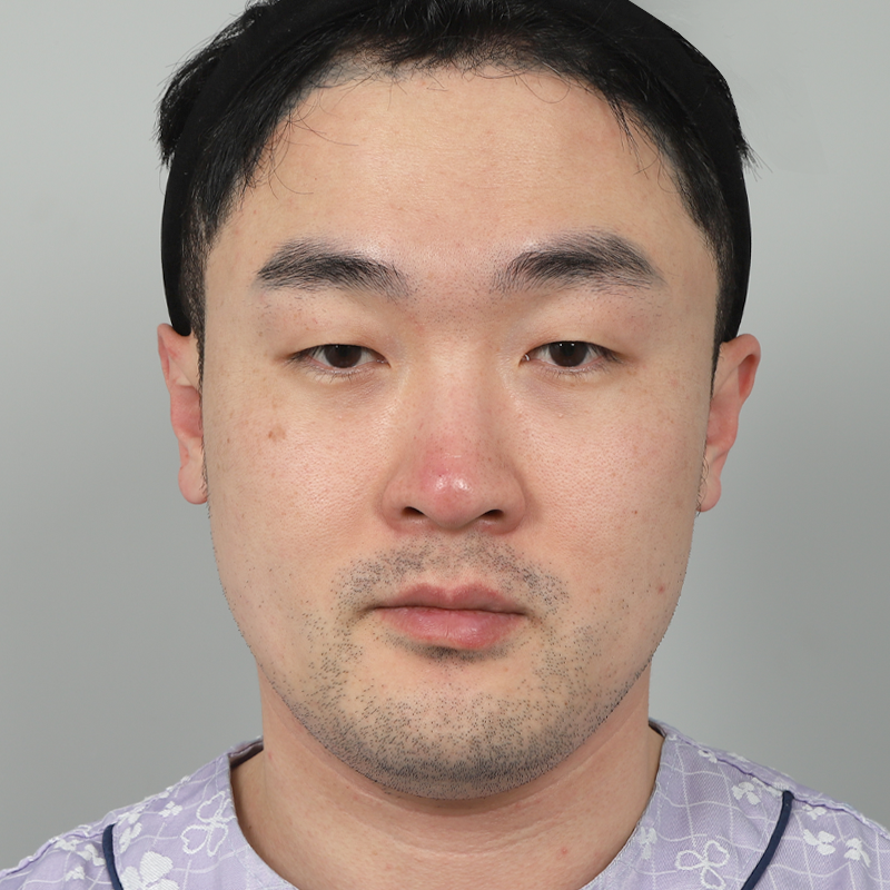 #Cắt mí một phần #Chỉnh sửa mắt #Sống mũi (silicone) #Đầu mũi (sụn tự thân)