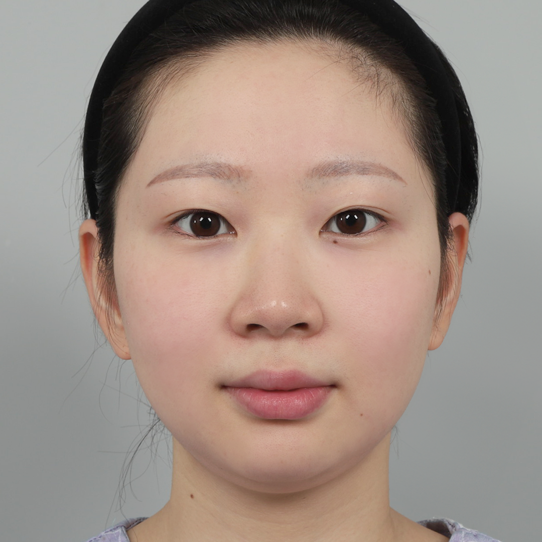 #Sống mũi (silicone) #Đầu mũi (sụn tự thân)