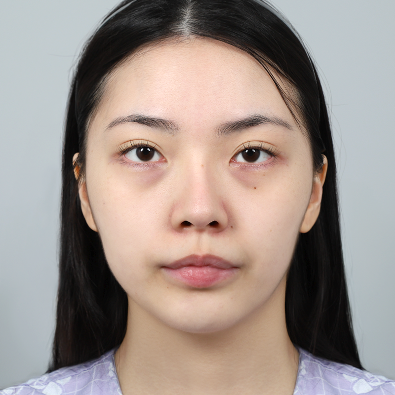 #Tái định vị bọng mắt dưới #Cấy mỡ mặt Cấy mỡ toàn mặt