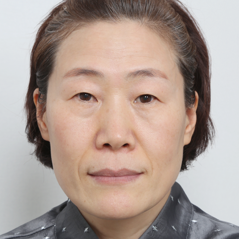 #Không rạch (chôn chỉ) #Mở rộng góc mắt ngoài và hạ mí dưới #Cắt da thừa, bọng mỡ mi dưới