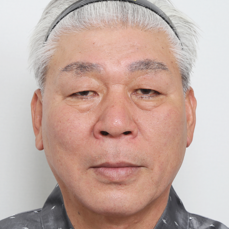 #Hạ mí mắt treo chân mày