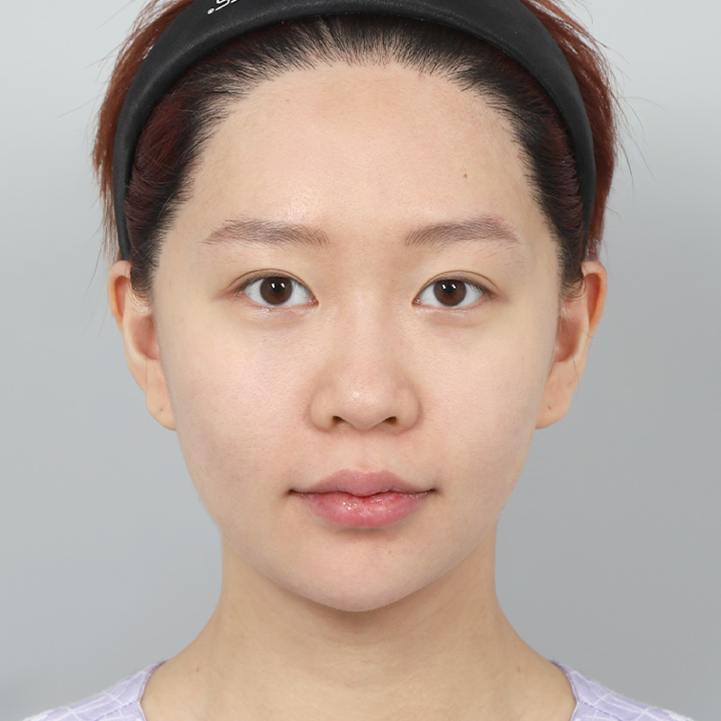 #Sốngmũi(silicone) #Đầumũi(sụn tự thân) #Chỉnhsửamũibè