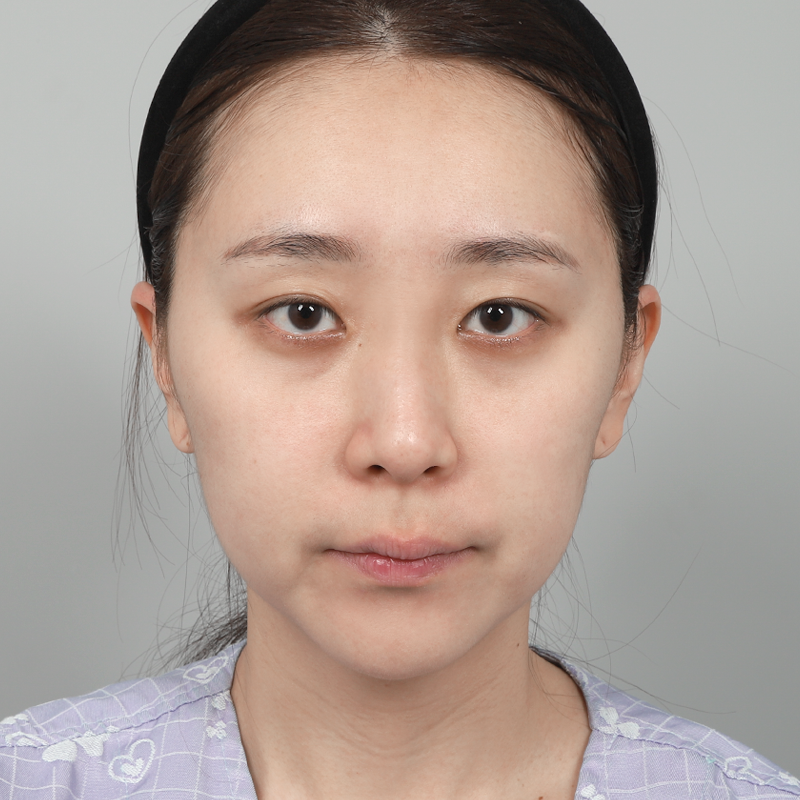 #Cắt mí một phần #Chỉnh sửa mắt #Tái tạo mỡ dưới mắt #Nâng mũi không dùng sụn nhân tạo #Đầu mũi (sụn tự thân)