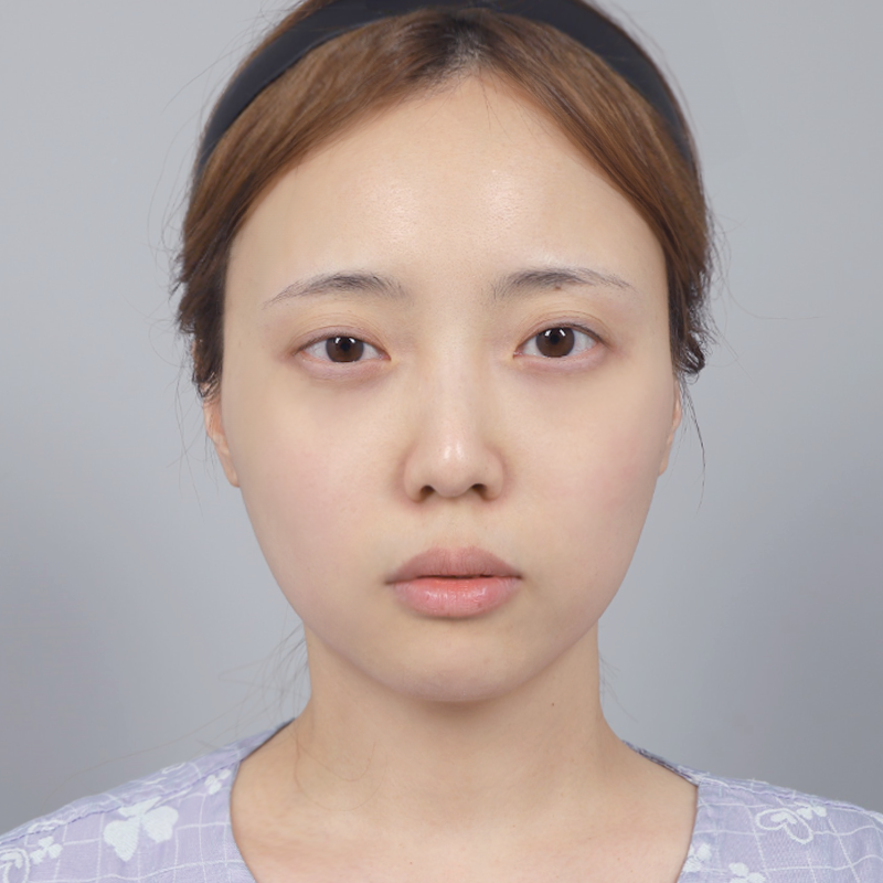 #Cắt mí một phần #Mở góc mắt trên #Cấy mỡ mí trên #Chỉnh hình mắt