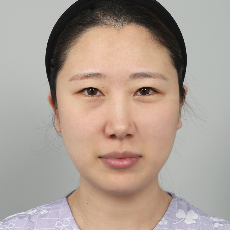 #Cắtmítoànphần #Mởrộnggócmatrongvàngoài #Lấymỡbọngmắttrên #Táitạomỡbọngmắtdưới #Phẫuthuậtsửamítrên