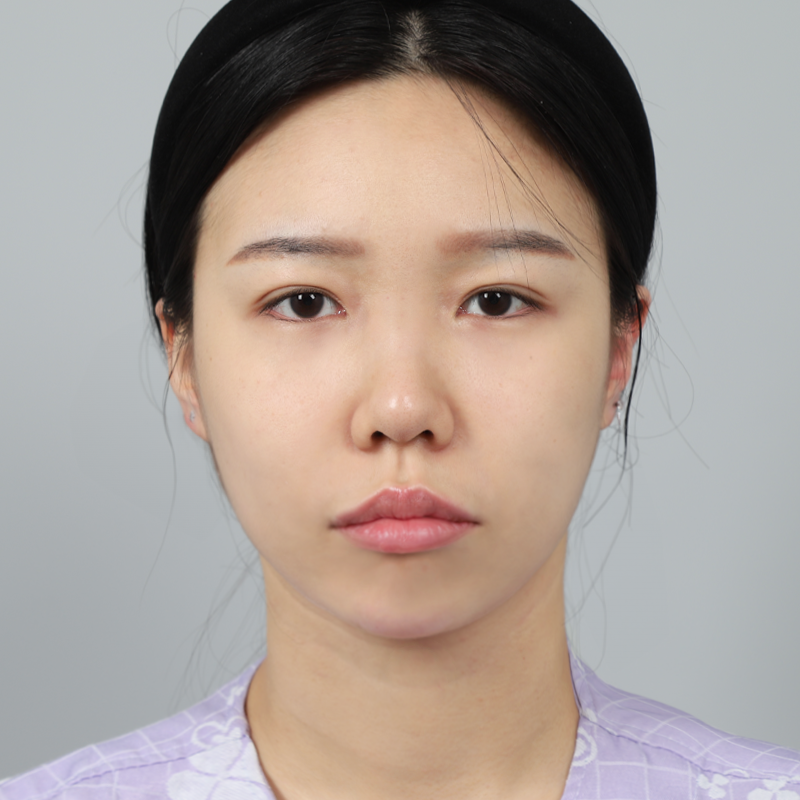 #Sống mũi (silicone) #Đầu mũi (sụn tự thân) #Cắt một phần #Mở góc mắt trên #Mở góc mắt dưới