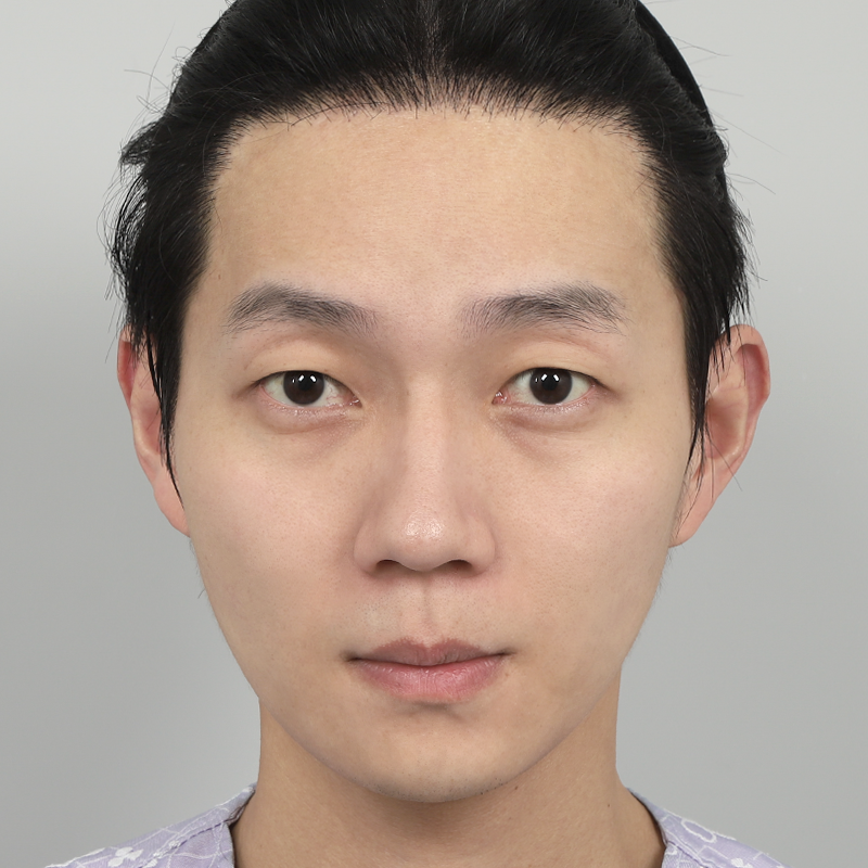 #Cắt mí một phần #Chỉnh sửa hình dáng mắt