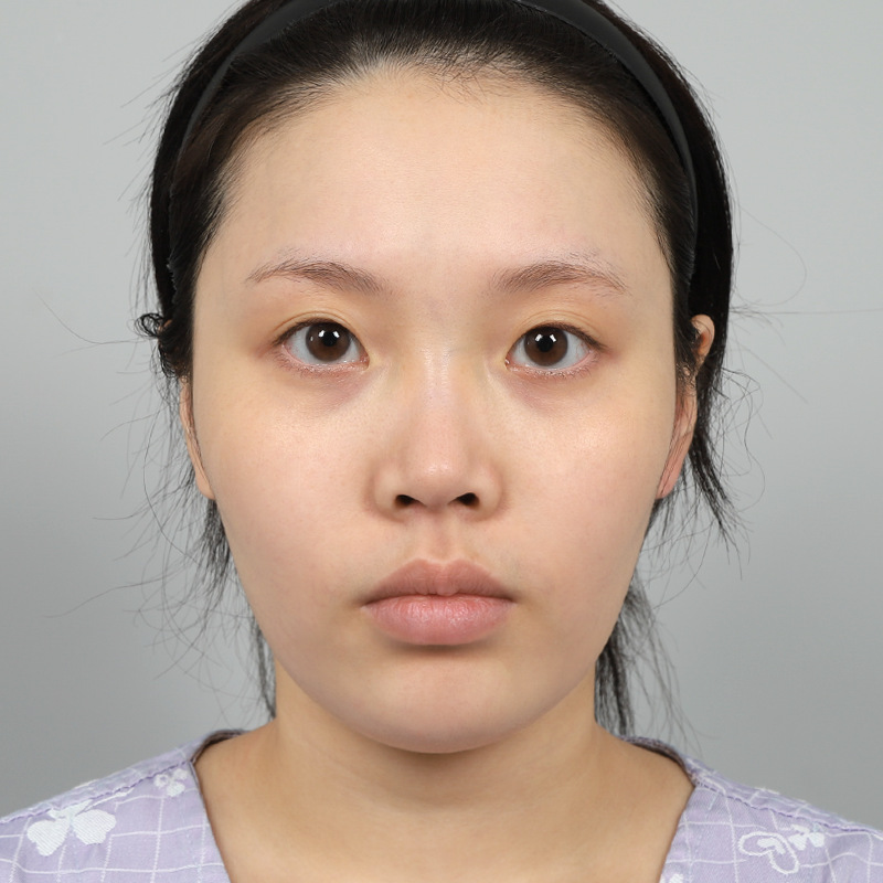 #Cắt một phần #Sống mũi (silicone) #Đầu mũi (sụn tự thân)