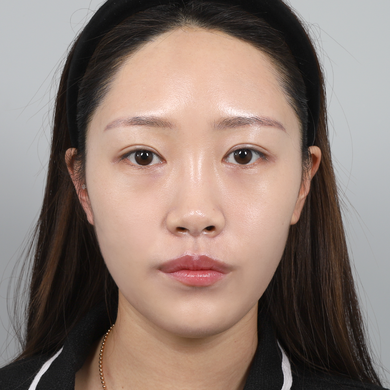 #Sống mũi (silicone) #Đầu mũi (sụn tự thân) #Tái tạo mỡ dưới mắt cấy mỡ toàn mặt