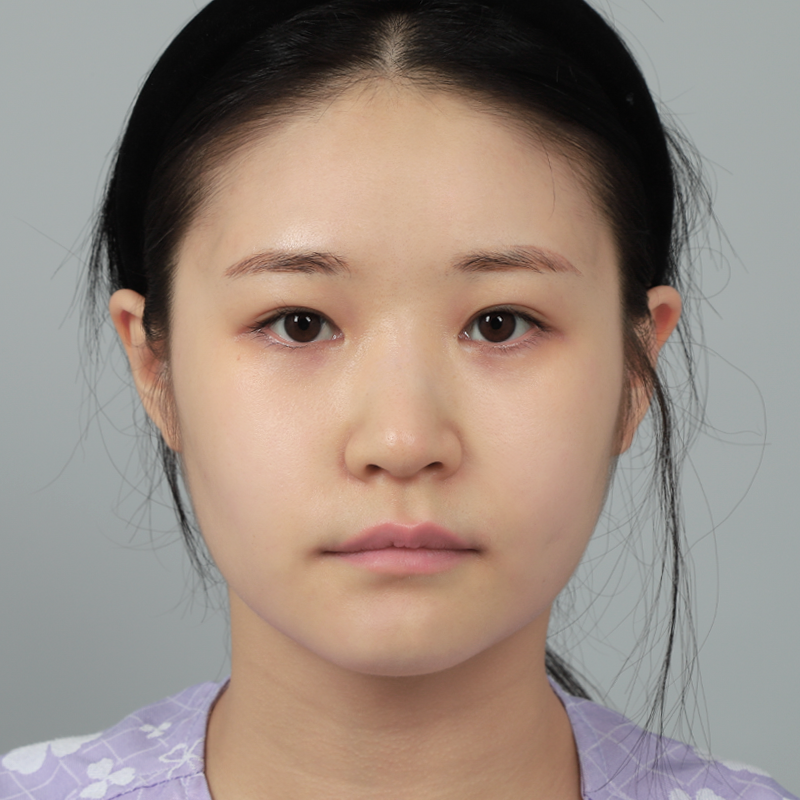 #Sốngmũi(silicone) #Đầumũi(sụn tự thân)