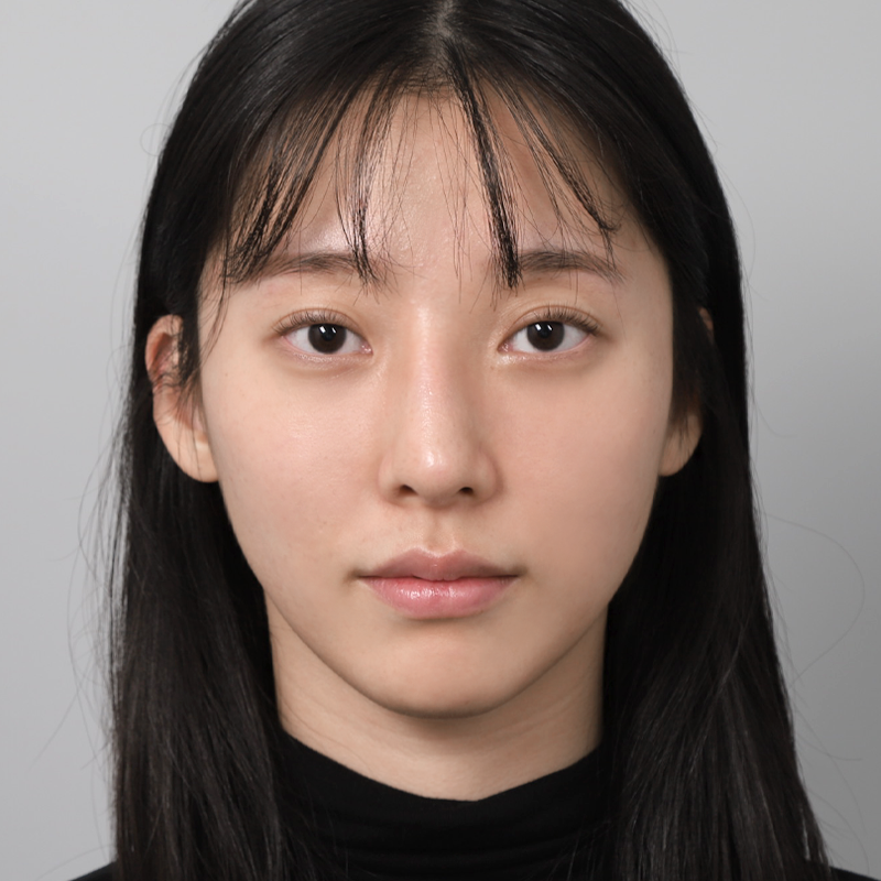 #Đầu mũi (sụn tự thân) #Phẫu thuật nâng mũi không dùng chất liệu độn #Chỉnh sửa mũi gồ #Tái phẫu thuật mũi