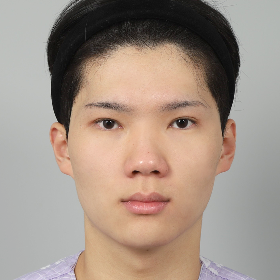 #Sống mũi (silicone) #Đầu mũi (sụn tự thân)